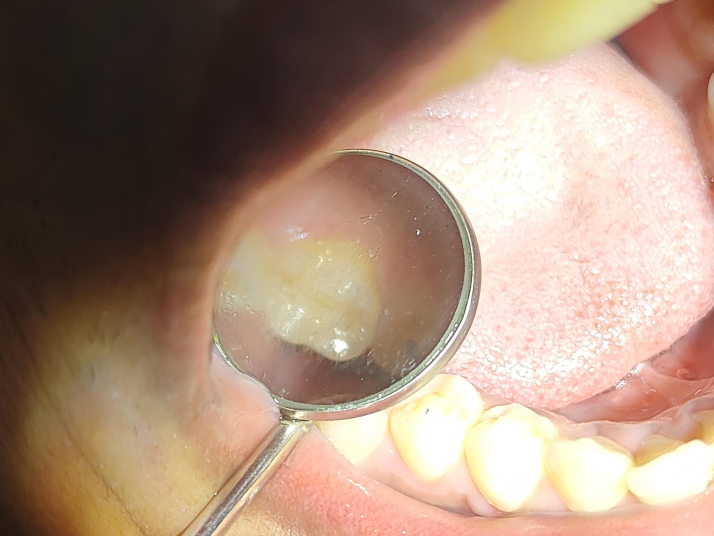 Clinical case at Prajwal Dental & General Clinic