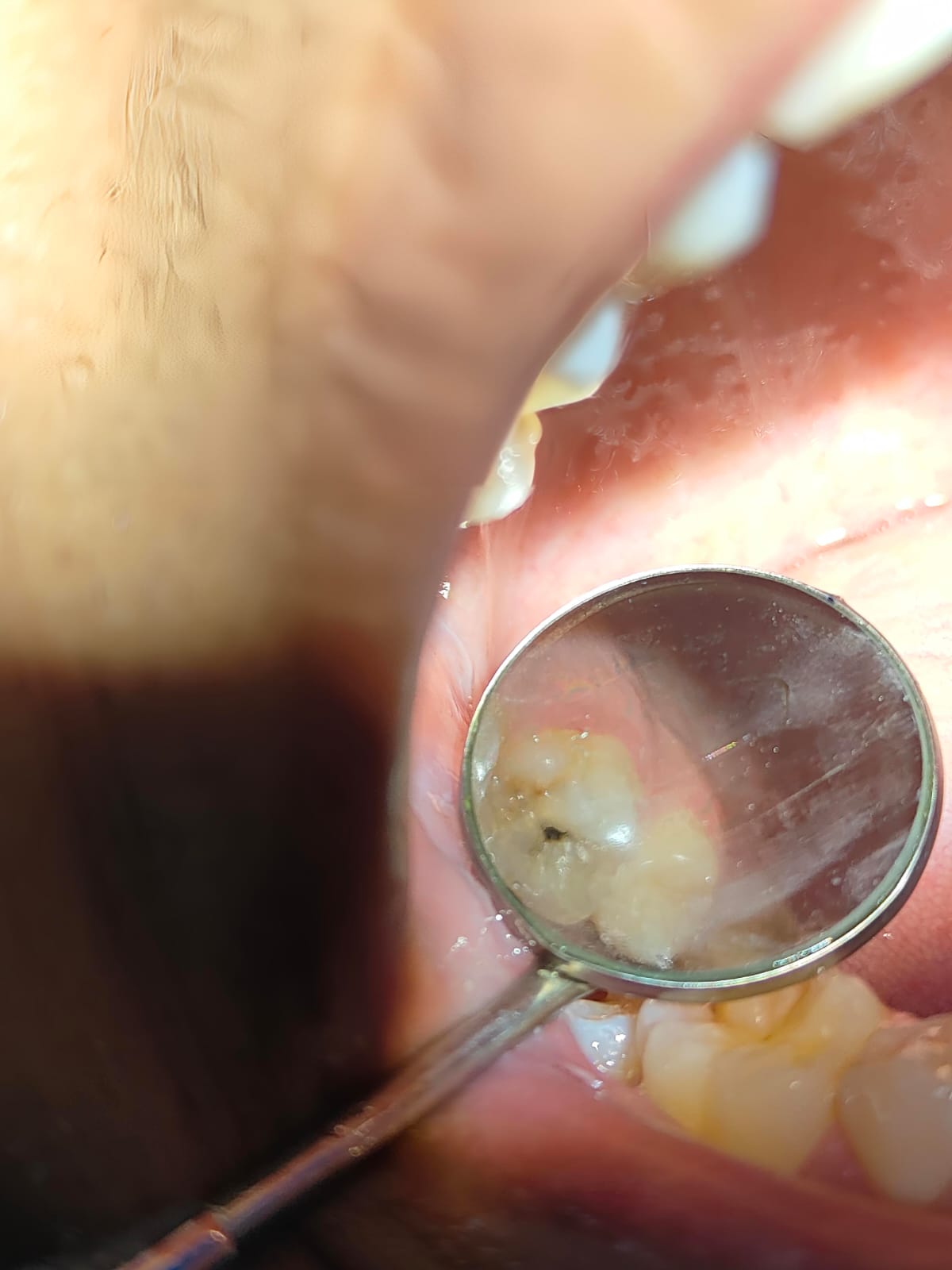Clinical case at Prajwal Dental & General Clinic
