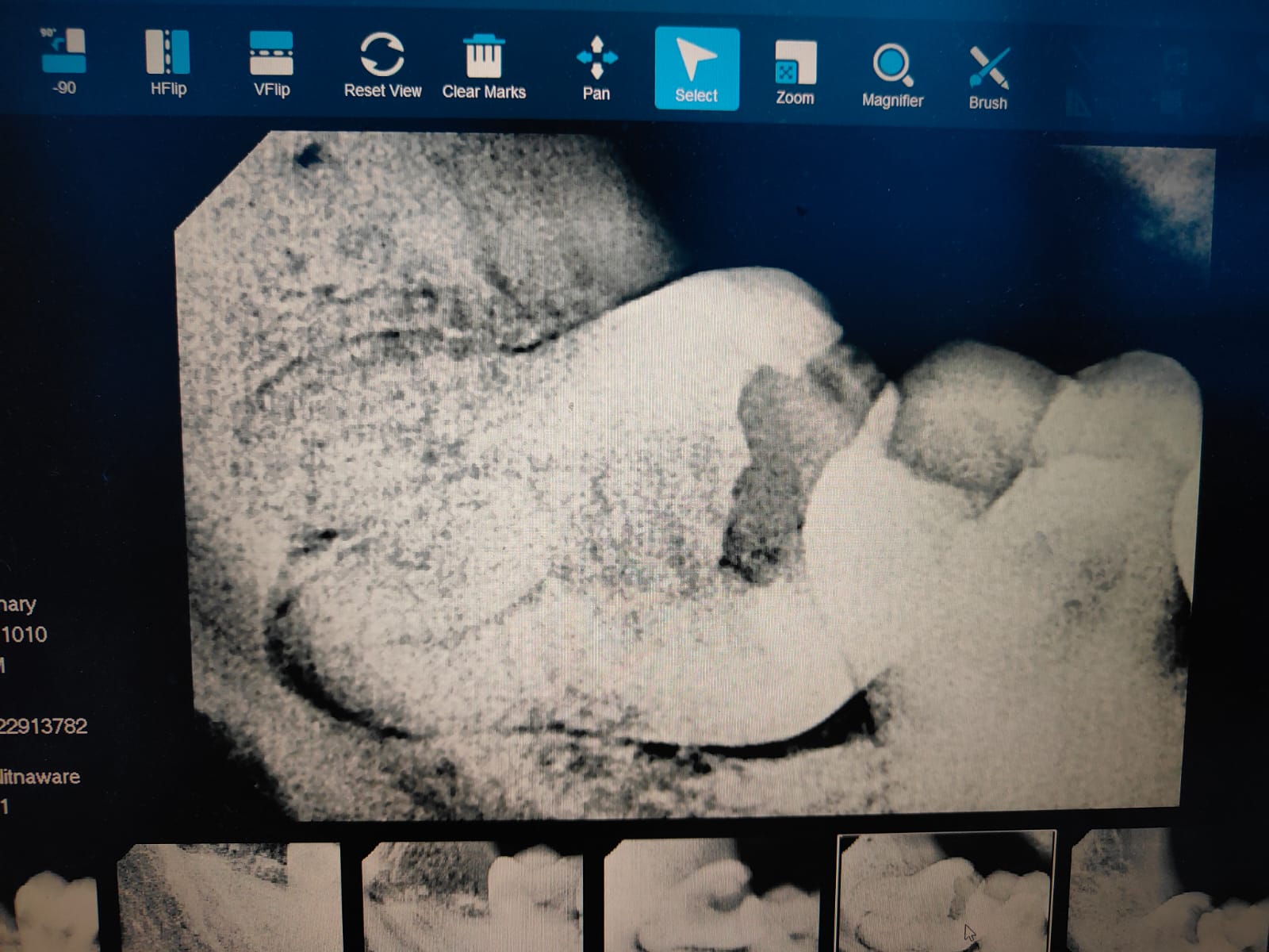 Clinical case at Prajwal Dental & General Clinic