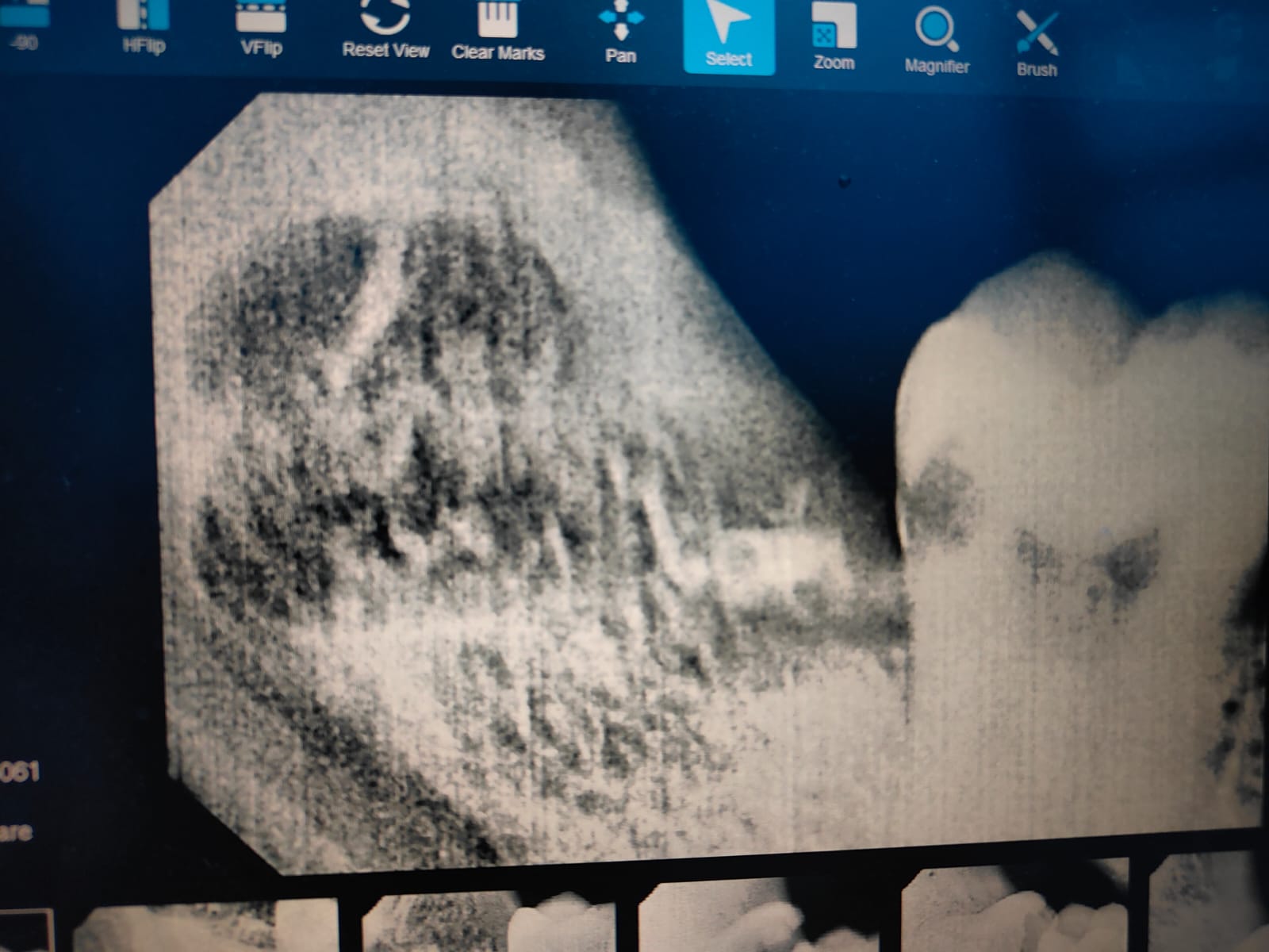 Clinical case at Prajwal Dental & General Clinic