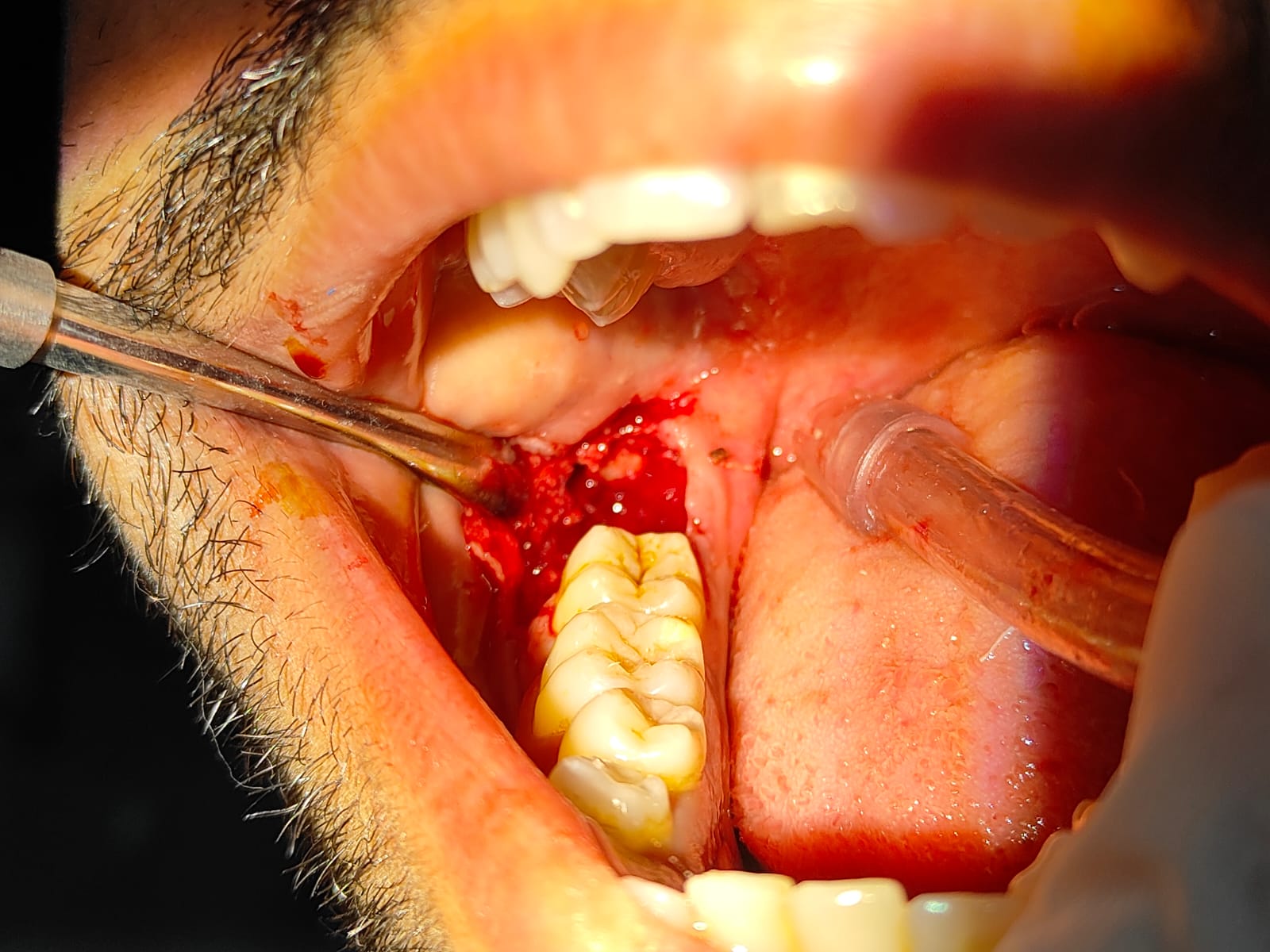 Clinical case at Prajwal Dental & General Clinic