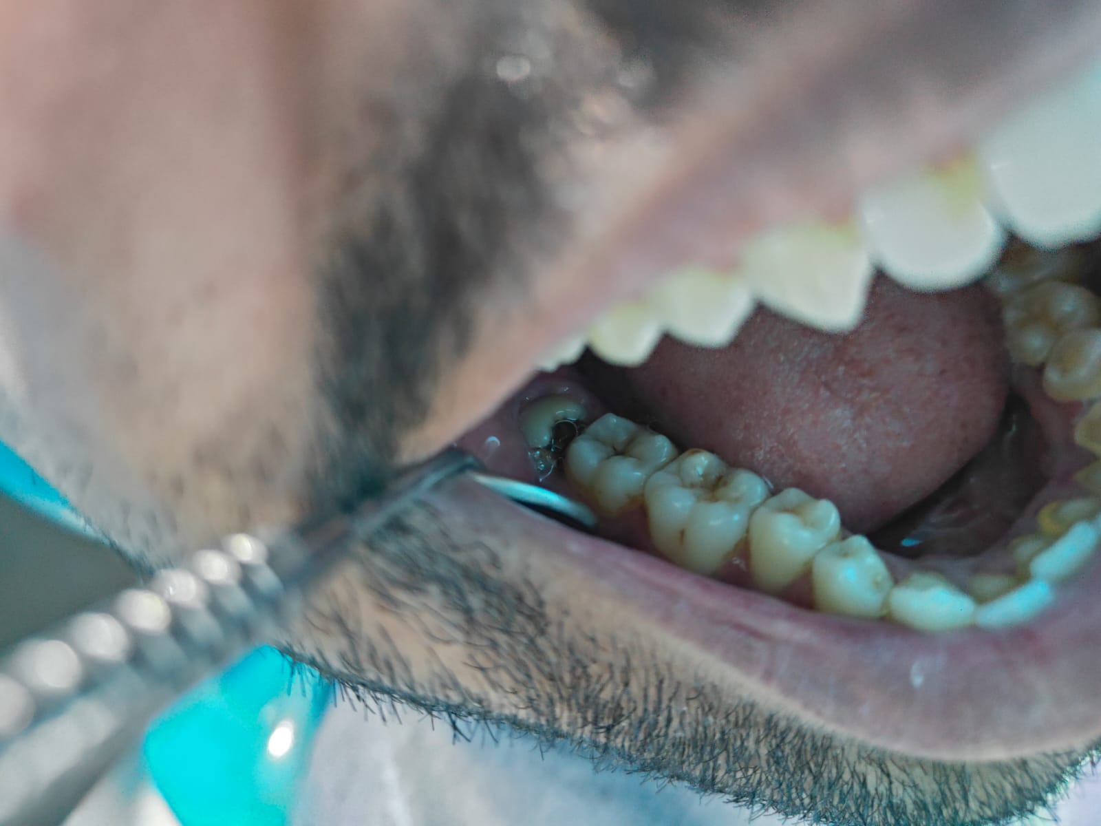 Clinical case at Prajwal Dental & General Clinic