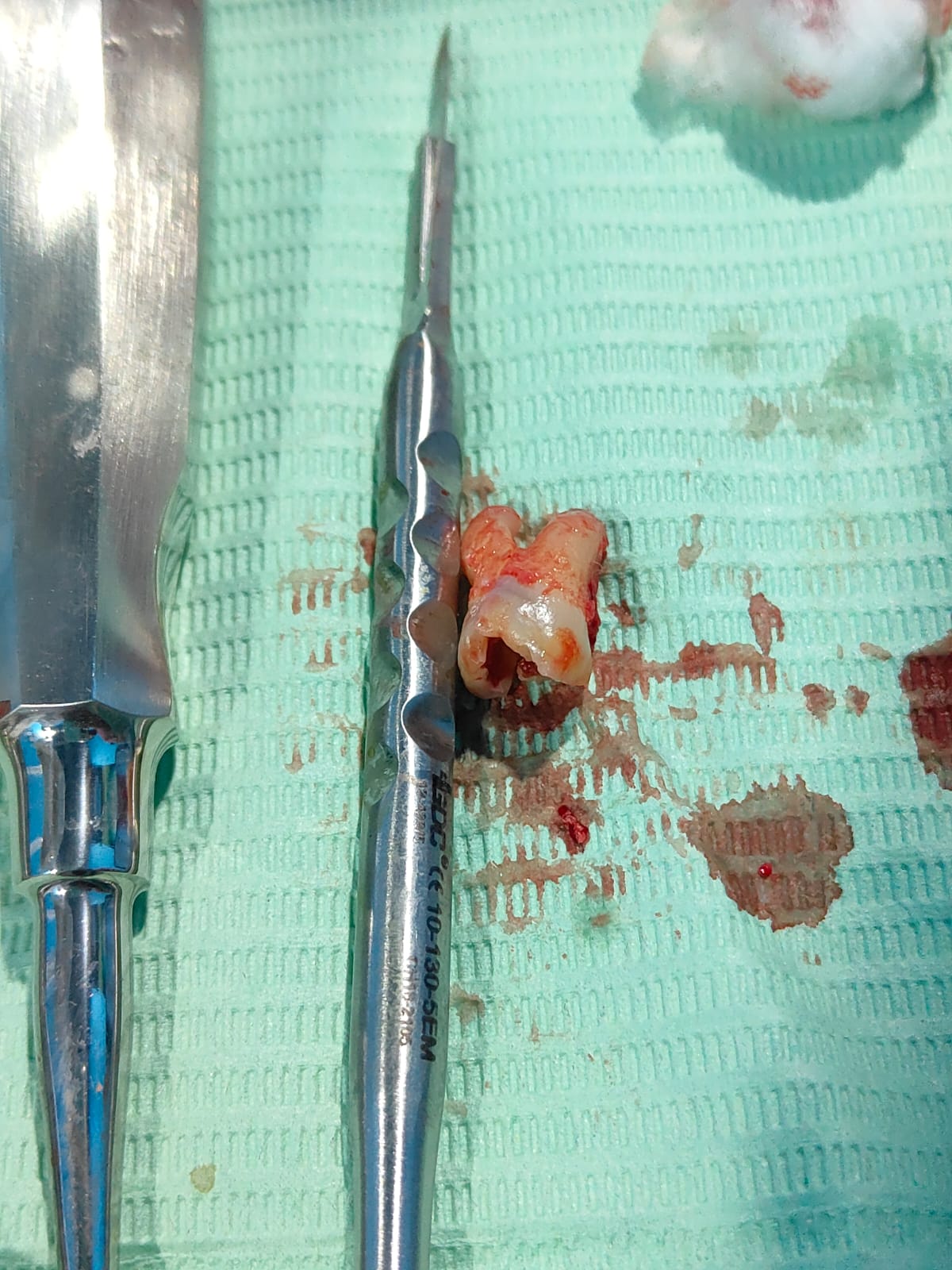 Clinical case at Prajwal Dental & General Clinic