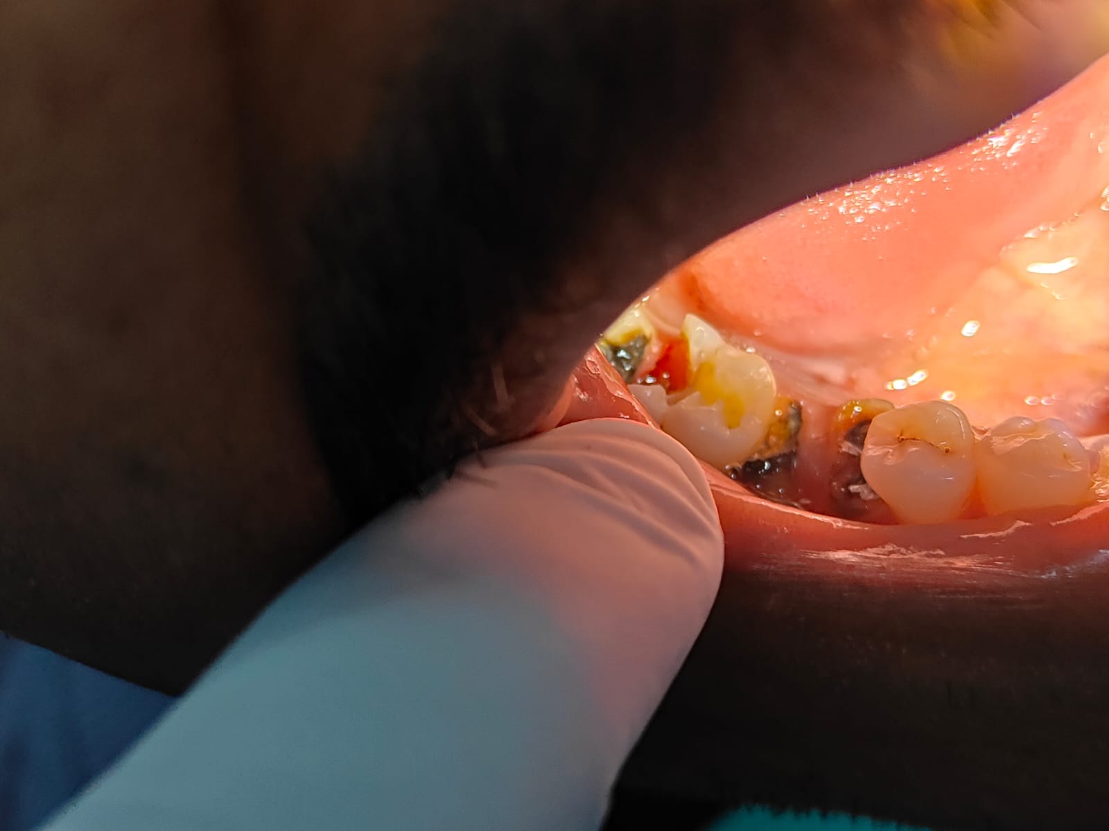 Clinical case at Prajwal Dental & General Clinic