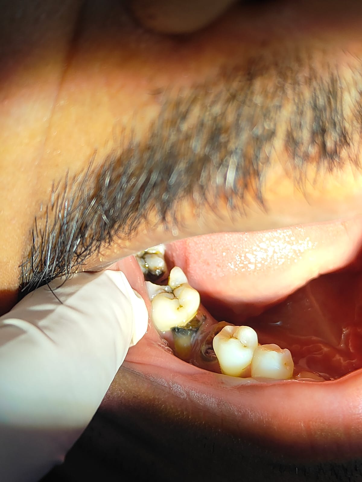 Clinical case at Prajwal Dental & General Clinic