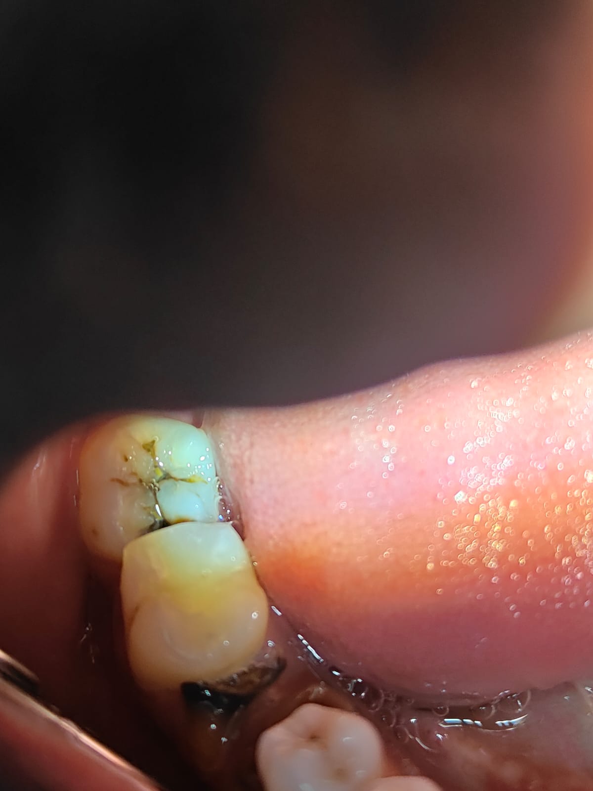Clinical case at Prajwal Dental & General Clinic
